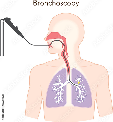 気管支鏡による肺がん検査のイラスト、Bronchoscopy