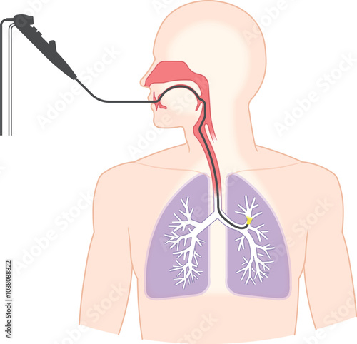 気管支鏡による肺がん検査のイラスト、Bronchoscopy