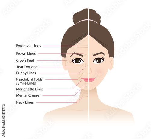 Comparison before and after facial wrinkles on woman face vector illustration. Forehead, Bunny, Marionette, Frown lines, Mental crease, Crows feet, Tear troughs, Nasolabial folds, Smile, Neck lines.