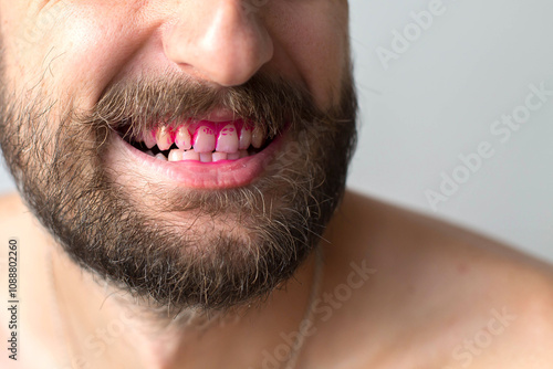 Close up of adult men s teeth with pink plaque indicator solution applied to teeth, concept of dental hygiene and health photo