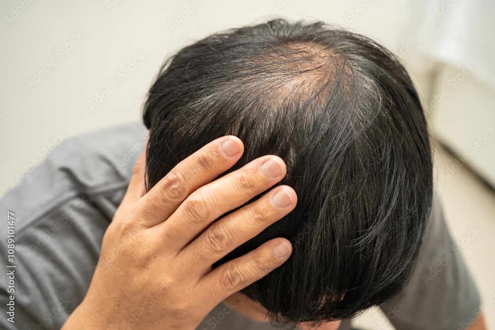 Bald head in man, hair loss treatment health problem. Bald head in man, hair loss treatment health problem.