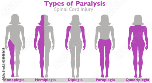 Palsy, spinal cord injury, paralysis types. Monoplegia, paraplegia, hemiplegia, diplegia, quadriplegia. causes, stroke, tumor, nerve damage brain injuries. Side woman, human body. Vector illsustration