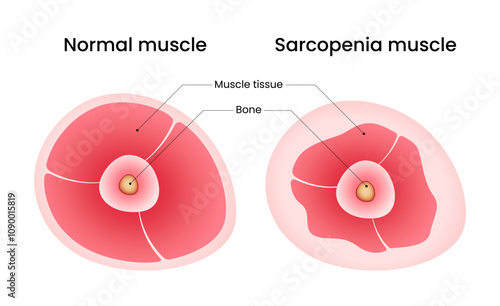 Normal muscle and Sarcopenia muscle