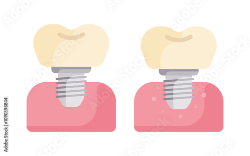 dental implant abutment fixture teeth tooth collection