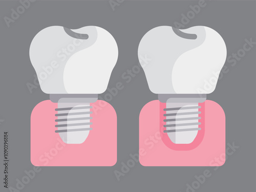 dental implant abutment fixture teeth tooth collection