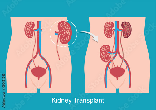 Kidney transplant involves placing a new donor kidney in body.