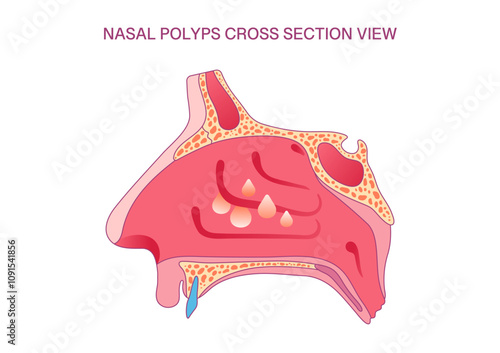 Nasal Polyps Cross-Section Diagram: Medical Illustration of Nasal Cavity with Polyps for Educational and Clinical Use