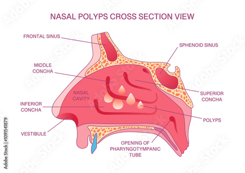 Labeled Nasal Polyps Cross-Section Diagram: Nasal Cavity, Sinuses, Concha, and Polyps Anatomy for Medical and Educational Purposes