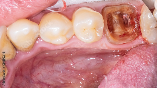 Картината върху платно Mandibular arch with decayed molar crown completely destroyed and damaged with remaining roots and canals endodontically treated prepared to be restored with a post and core build-up restoration