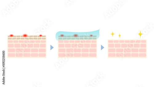 ケミカルピーリングの仕組みのイラスト