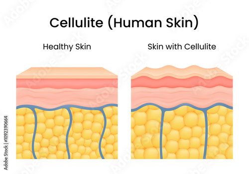Differences in skin structure between healthy skin and skin with cellulite