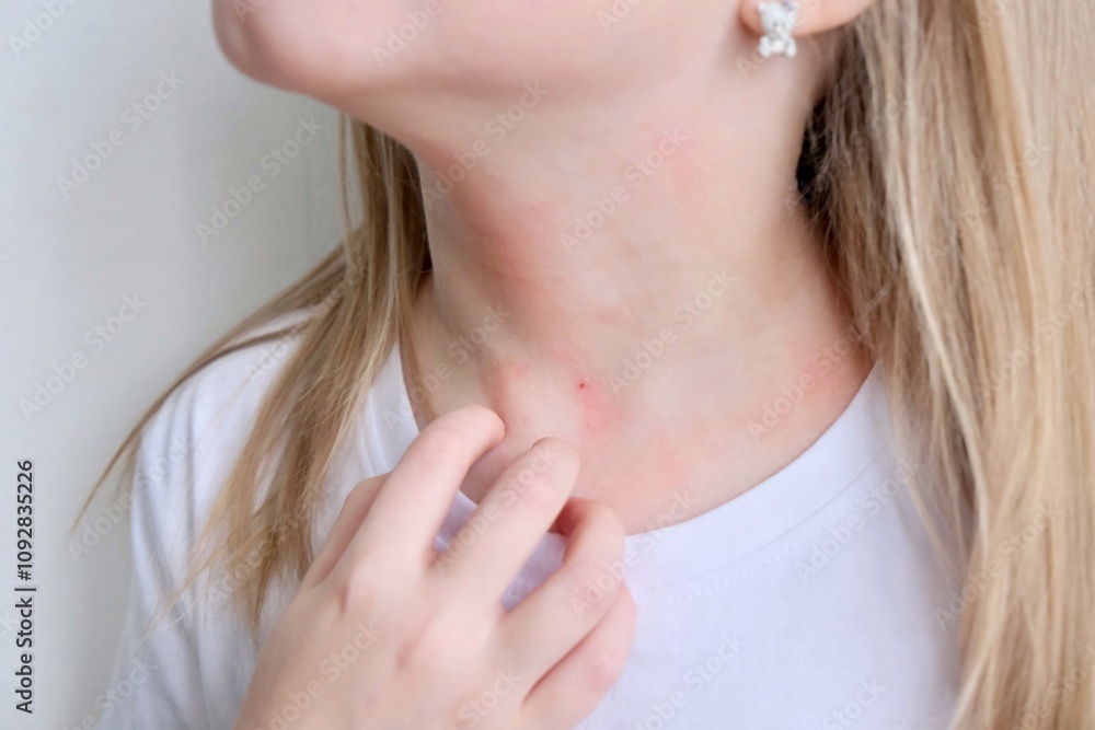Naklejka premium The child scratches atopic skin. Dermatitis, diathesis, allergy on the child's face. 