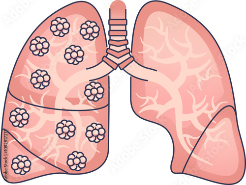 Illustration of human lungs showing bronchi and alveoli.