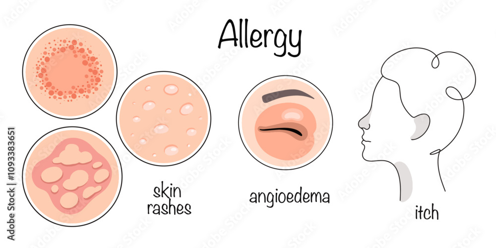 Allergy Allergy