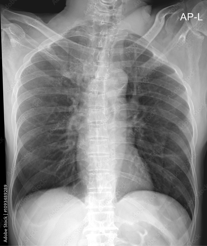 Chest X-ray for Evaluation of Lung Health and Pulmonary Conditions Chest X-ray for Evaluation of Lung Health and Pulmonary Conditions