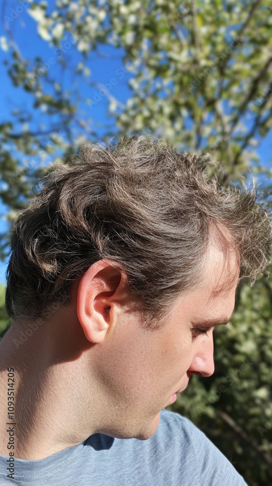 Young adult with excessive shedding resulting in noticeable thinning throughout their scalp Young adult with excessive shedding resulting in noticeable thinning throughout their scalp