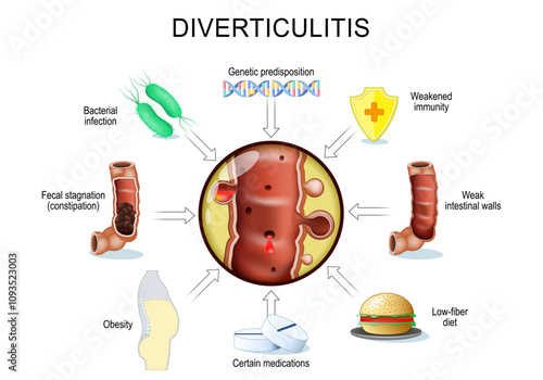 diverticulitis progression