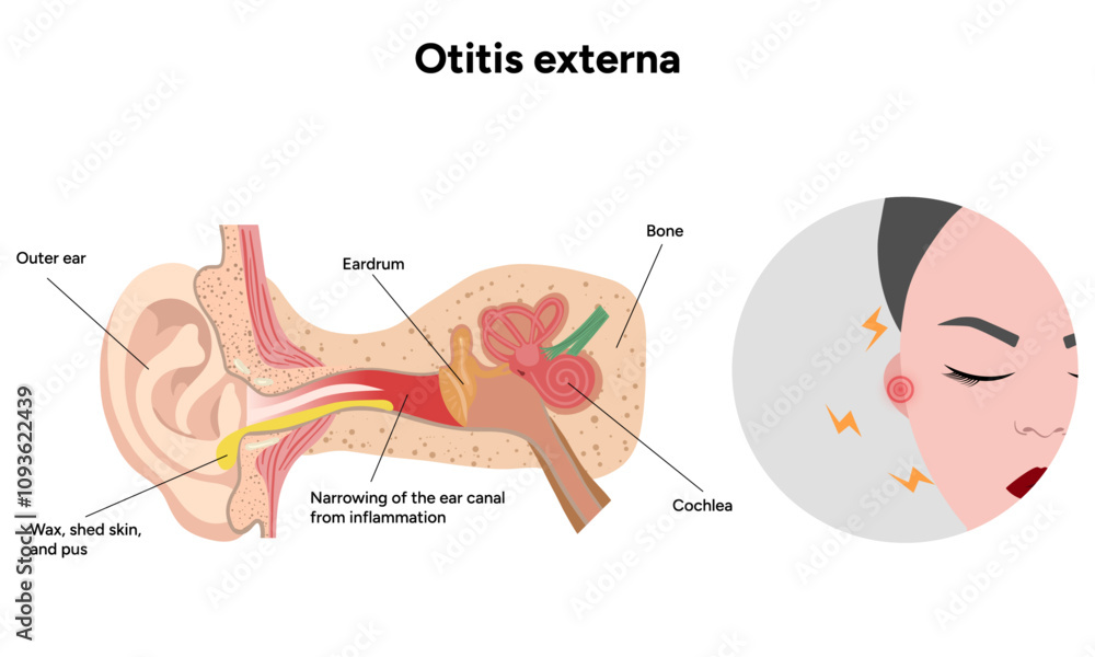 Obraz premium Otitis externa anatomy ear disease inflammation 