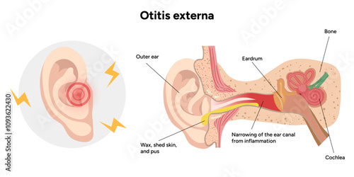 Otitis externa anatomy ear disease inflammation 