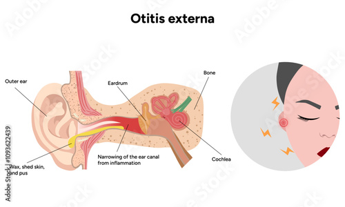 Otitis externa anatomy ear disease inflammation 