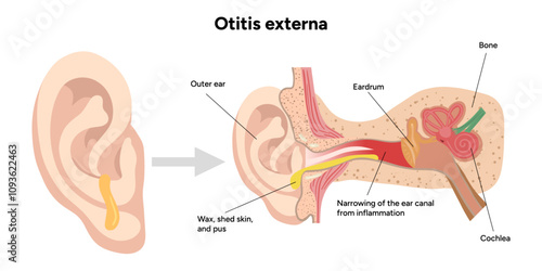 Otitis externa anatomy ear disease inflammation 