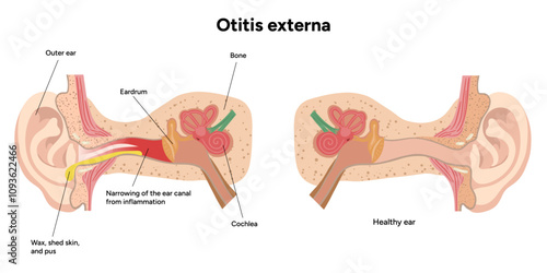 Otitis externa anatomy ear disease inflammation 