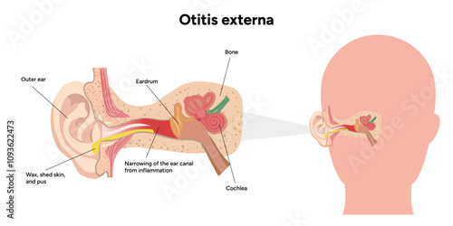 Otitis externa anatomy ear disease inflammation 
