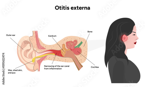 Otitis externa anatomy ear disease inflammation 