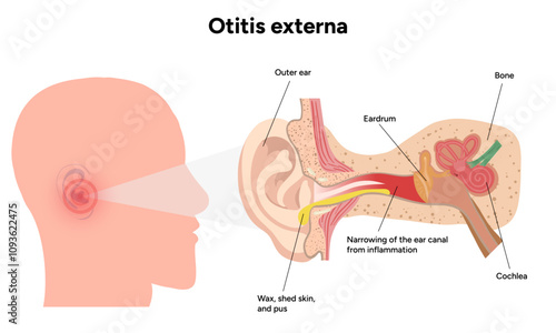 Otitis externa anatomy ear disease inflammation 
