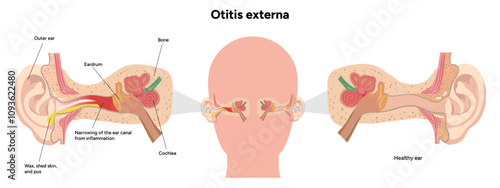 Otitis externa anatomy ear disease inflammation 