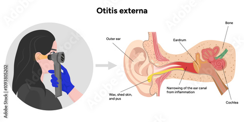 Otitis externa anatomy ear disease inflammation 