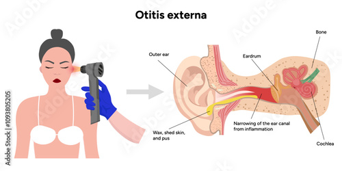 Otitis externa anatomy ear disease inflammation and check up in doctor appointment 