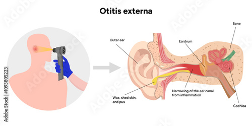 Otitis externa anatomy ear disease inflammation and check up in doctor appointment 