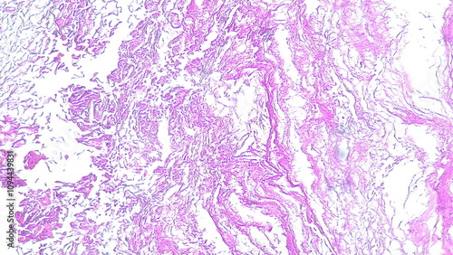 Photomicrograph showing histology of a atheroma cyst on the thorax in the anatomical pathology laboratory photo