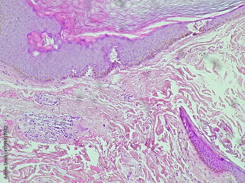 Photomicrograph showing histology of a atheroma cyst on the thorax in the anatomical pathology laboratory photo