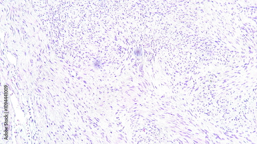 Photomicrograph of schwannoma in cpa tumor, a benign soft tissue tumor of the peripheral nervous system. photo