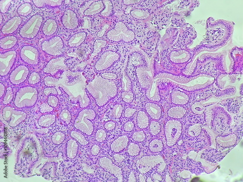 Human cell tissue under microscope in pathology laboratory. Microscopic picture of chronic gastric disease