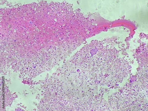 invasive carcinoma of the left lung. Malignant cells. Histological tissue under a microscope photo