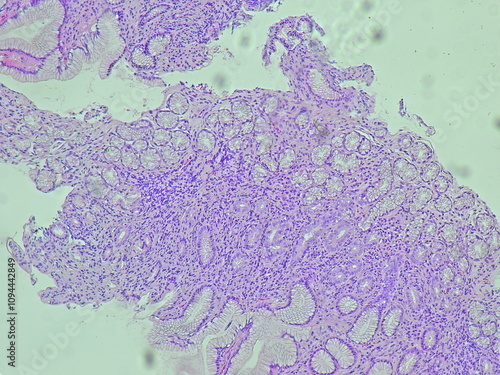 Human cell tissue under microscope in pathology laboratory. Microscopic picture of chronic gastric disease showing Helicobacter pylori bacterial infection, hematoxylin eosin staining photo