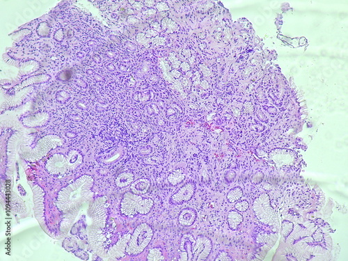 Human cell tissue under microscope in pathology laboratory. Microscopic picture of chronic gastric disease showing Helicobacter pylori bacterial infection, hematoxylin eosin staining photo