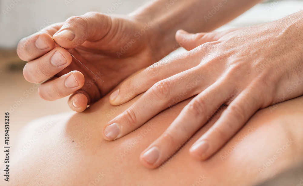 Close-up of therapist's hands performing acupuncture treatment by gently inserting thin needle into patient's skin. Image highlights relaxation and alternative medicine healthcare practices in clinic Close-up of therapist's hands performing acupuncture treatment by gently inserting thin needle into patient's skin. Image highlights relaxation and alternative medicine healthcare practices in clinic