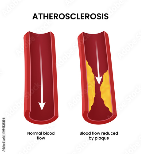 Atherosclerosis of normal blood and blood flow reduced by plaque