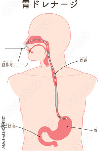 胃ドレナージ、Nasogastric tube