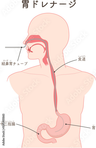 胃ドレナージ、Nasogastric tube