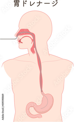 胃ドレナージ、Nasogastric tube