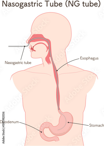 胃ドレナージ、Nasogastric tube
