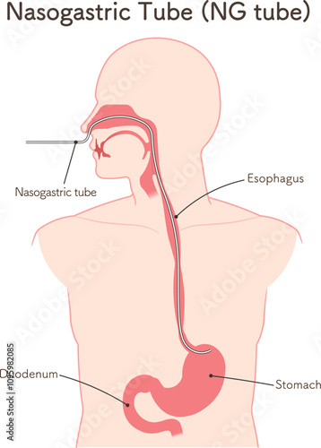 胃ドレナージ、Nasogastric tube