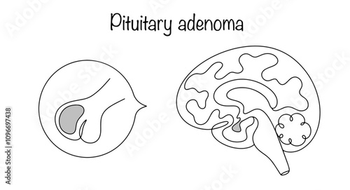 Pituitary adenoma photo