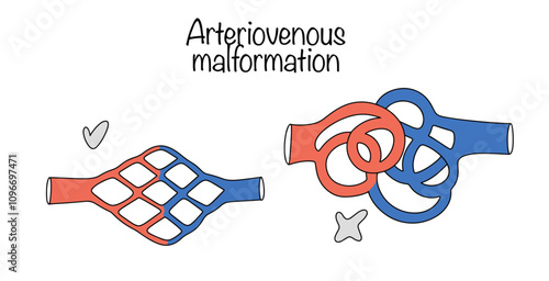 Arteriovenous malformation