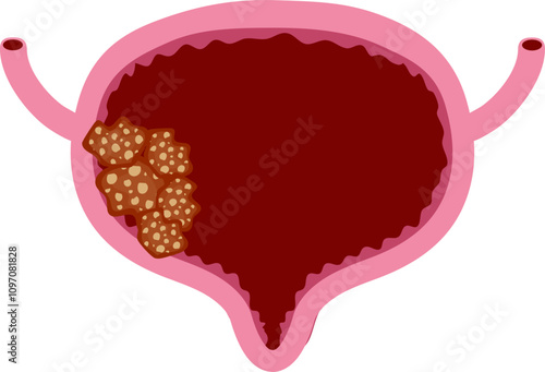 Bladder disease illustration. Urinary tract infection. Bladder cancer. Bladder stones. Bladder inconvenience.